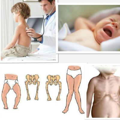 Nguyên nhân dẫn đến còi xương ở trẻ